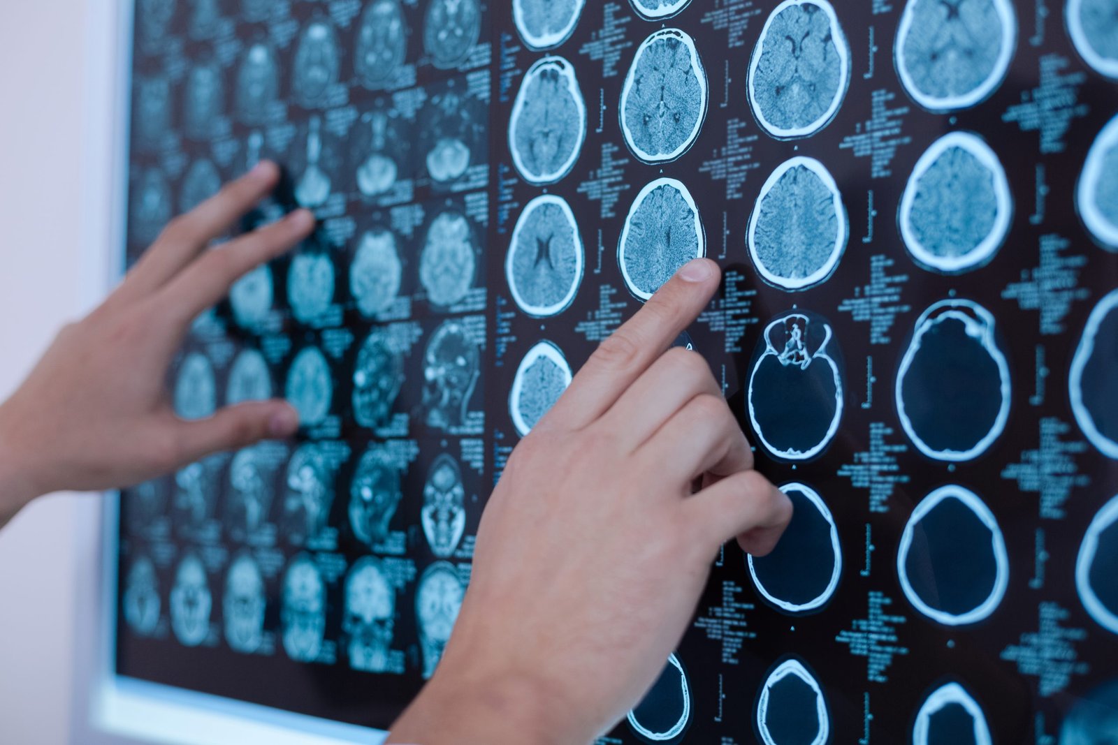 close up x ray images human brain being put whiteboard by nice professional oncologist scaled